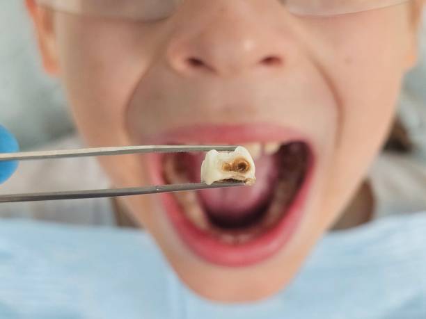 Best Emergency Tooth Extraction  in Hansville, WA